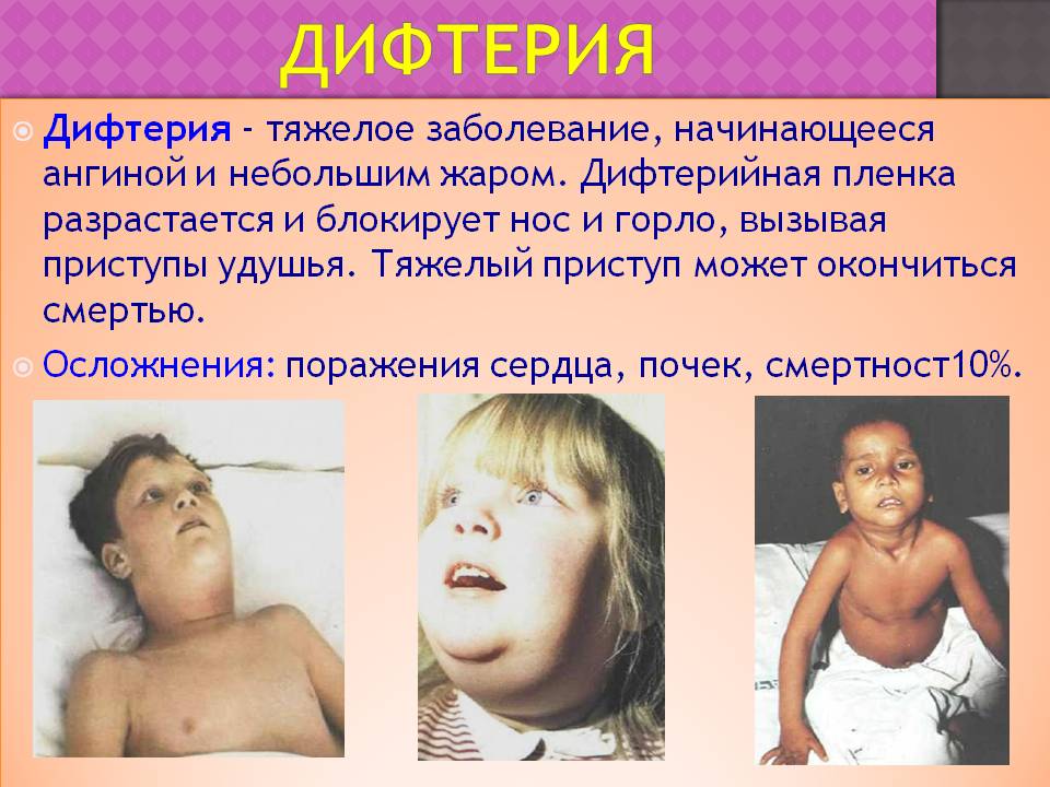 Дифтерия