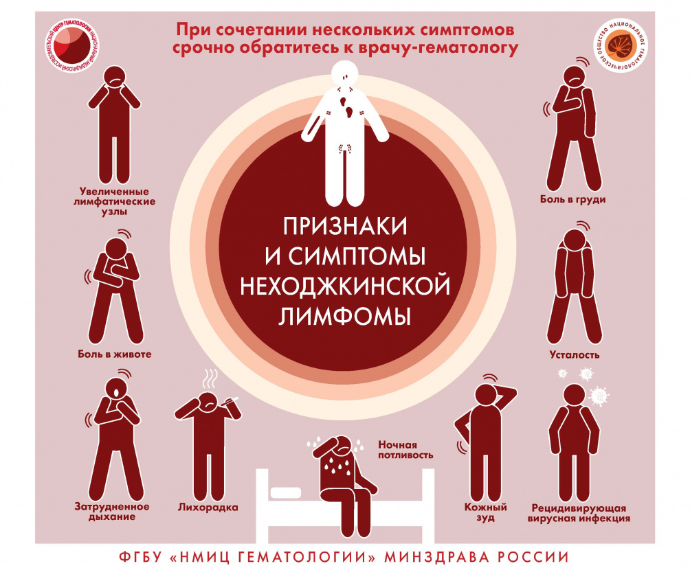 Признаки и симптомы неходжкинской лимфомы